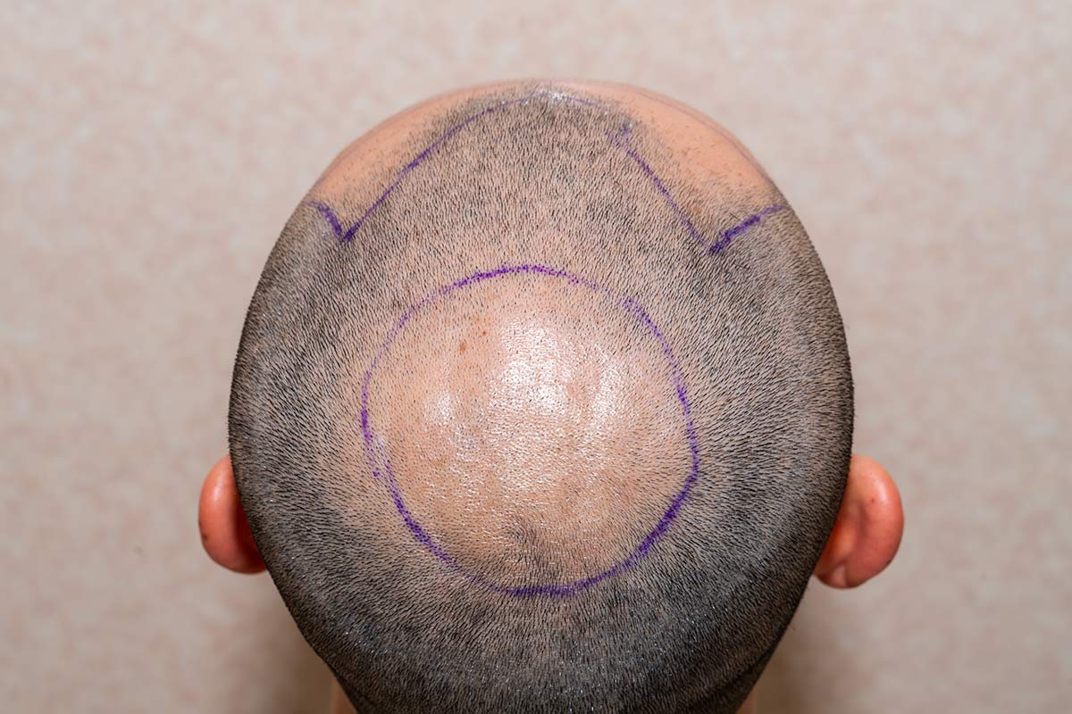 effet crâne rasé homme femme DPC Dermopigmentation pour Hommes capillaire Saint-Nazaire, Hair Tattoo, micro-pigmentation des cheveux, tatouage cheveux, micro-tatouage contre la calvitie