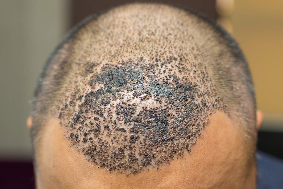 effet crâne rasé homme femme DPC Dermopigmentation pour Hommes capillaire Saint-Nazaire, Hair Tattoo, micro-pigmentation des cheveux, tatouage cheveux, micro-tatouage contre la calvitie