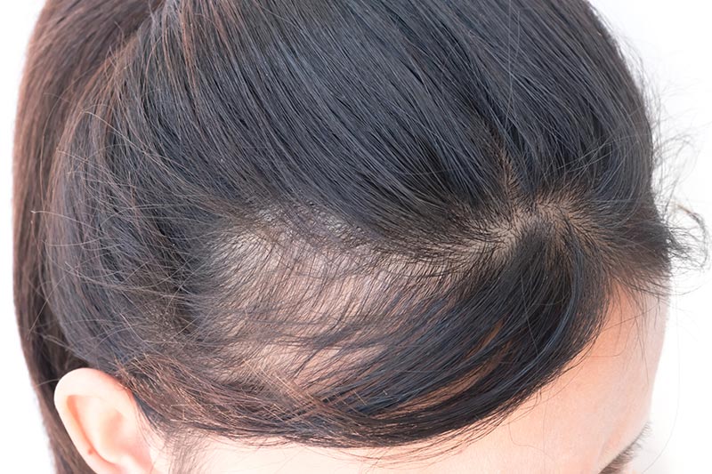 Manquement ligne frontale Micropigmentation pour femme, feminine,DPC - Dermopigmentation capillaire à Saint-Nazaire, Hair Tattoo, micro-pigmentation des cheveux, tatouage cheveux, micro-tatouage contre la calvitie