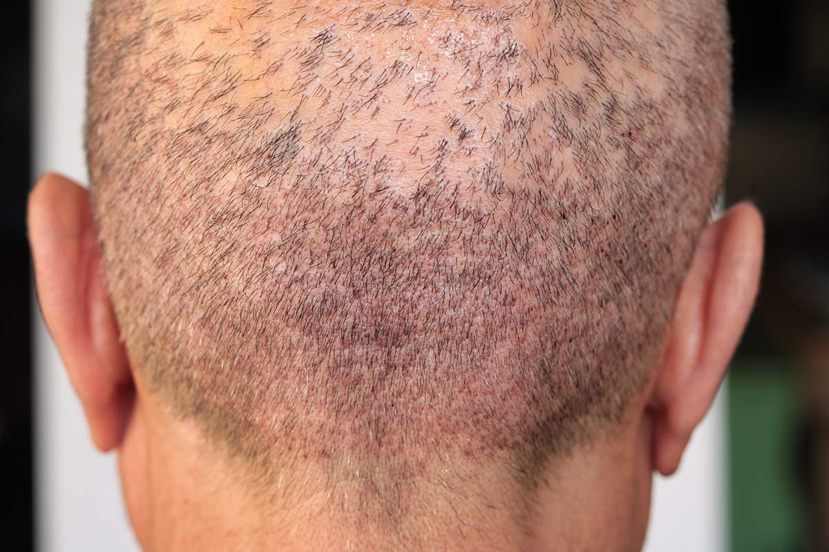 effet crâne rasé homme femme DPC Dermopigmentation pour Hommes capillaire Saint-Nazaire, Hair Tattoo, micro-pigmentation des cheveux, tatouage cheveux, micro-tatouage contre la calvitie