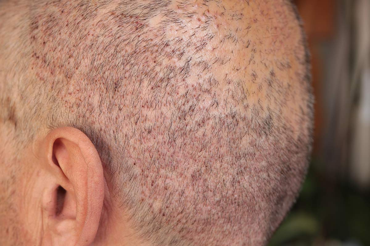 effet crâne rasé homme femme DPC Dermopigmentation pour Hommes capillaire Saint-Nazaire, Hair Tattoo, micro-pigmentation des cheveux, tatouage cheveux, micro-tatouage contre la calvitie