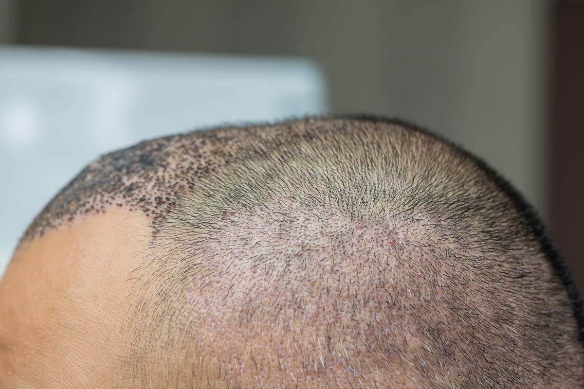 effet crâne rasé homme femme DPC Dermopigmentation pour Hommes capillaire Saint-Nazaire, Hair Tattoo, micro-pigmentation des cheveux, tatouage cheveux, micro-tatouage contre la calvitie