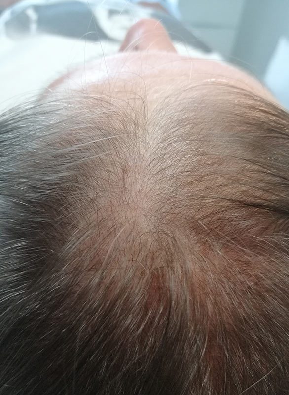 Micropigmentation pour Femme, DPC BY FRED - Dermopigmentation Capillaire à Saint-Nazaire